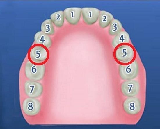 Tình trạng mất răng số 5 gây ra nhiều hậu quả nghiêm trọng