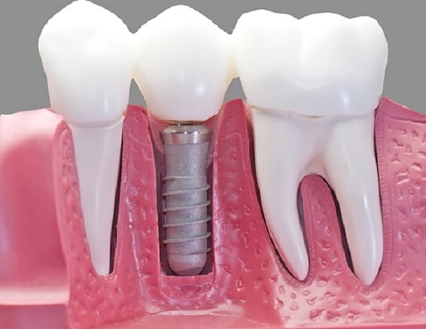 Chi phí trồng răng Implant cao hơn so với những phương pháp khác