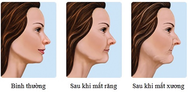 Tiêu xương hàm gây ra nhiều vấn đề răng miệng cũng như thẩm mỹ khuôn mặt.