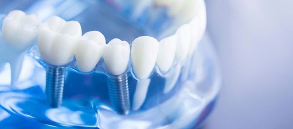 Răng Implant gồm 3 phần là: trụ Implant được làm bằng Titanium, khớp nối Abutment và mão răng sứ