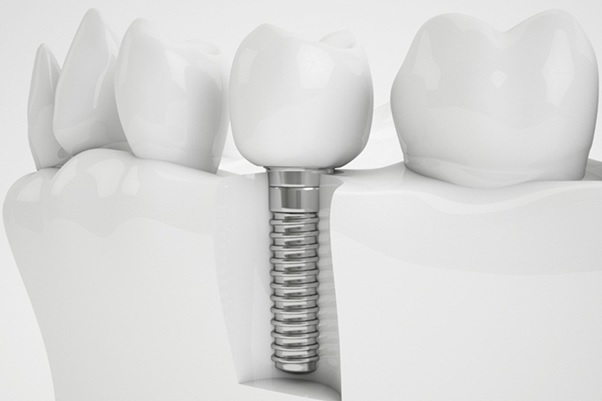Trồng răng số 7 bằng phương pháp cấy ghép Implant được đánh giá là tốt nhất hiện nay