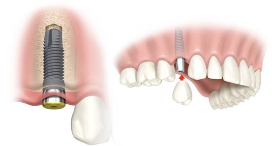 Trồng răng Implant là phương pháp trồng răng đơn lẻ mang đến hiệu quả cao nhất hiện nay