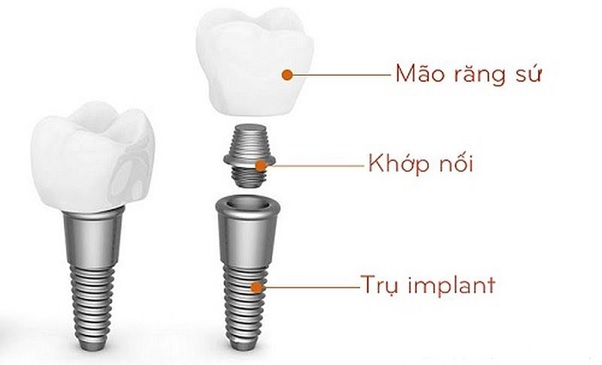 Cấu tạo của răng Implant