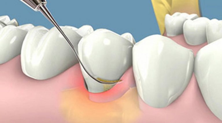 Cạọ vôi (cao) răng là gì?