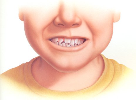 Tình trạng răng lệch lạc