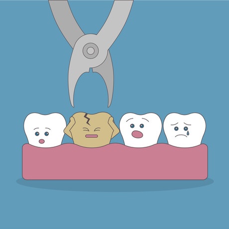 Tình trạng mất răng số 7 nếu không được can thiệp phục hồi sớm sẽ gây ra nhiều hậu quả nghiêm trọng