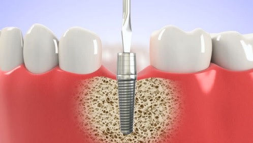 Việc trồng răng Implant có tốt không còn phụ thuộc vào nhiều yếu tố