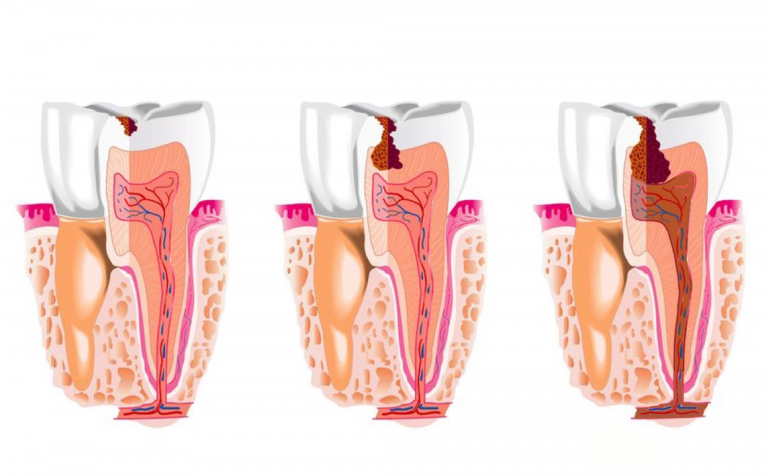 Tình trạng răng bị sâu có thể do nhiều nguyên nhân khác nhau