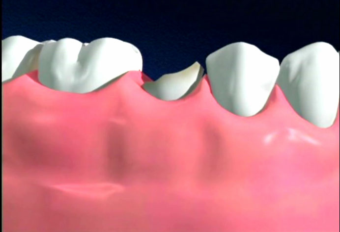 Răng bị mẻ sẽ rất nhạy cảm, yếu hơn so với các răng kế cận
