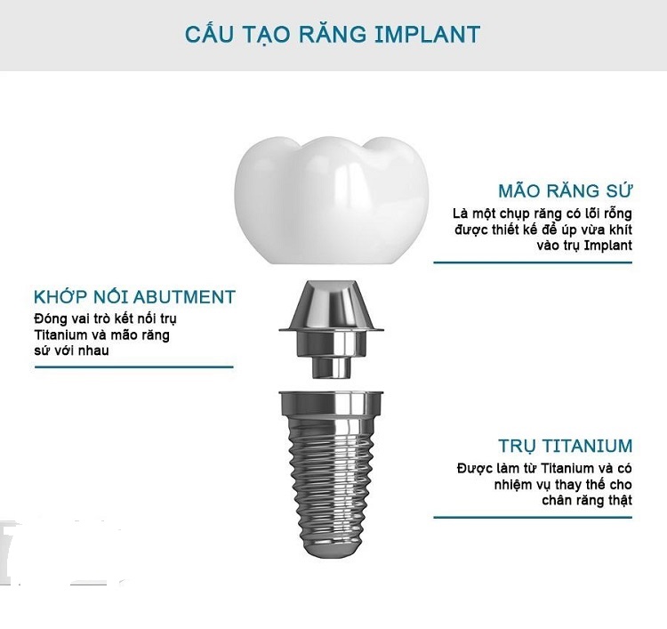 Cấu tạo của Implant Hàn Quốc