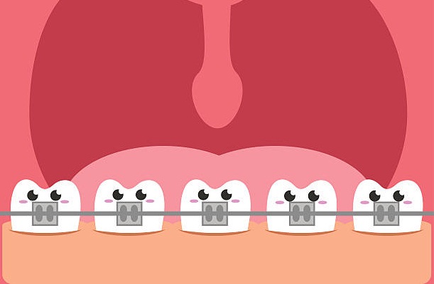 Niềng răng có hại không? Có ảnh hưởng gì không?
