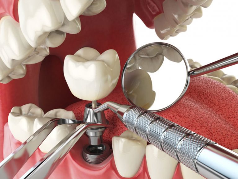Cấy ghép Implant - Phương pháp trồng răng hiện đại nhất hiện nay