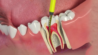 Điều trị tủy răng hoặc bọc răng sứ - Cách chữa răng sâu vào tủy