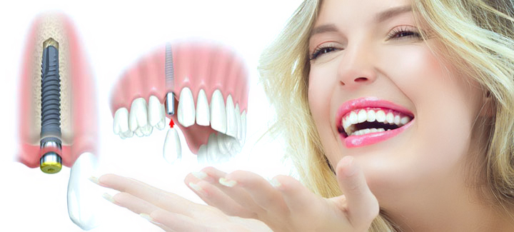 Nếu bạn áp dụng chế độ chăm sóc răng khoa học có thể suy trì tuổi thọ răng Implant vĩnh viễn, đảm bảo ăn nhai thoải mái