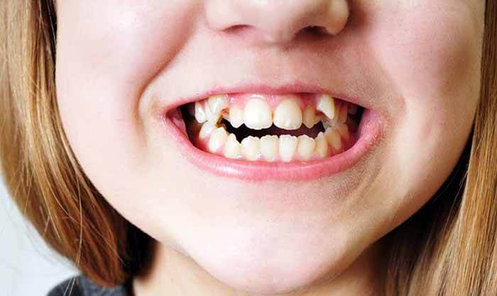 Răng lệch lạc gây nhiều bất tiện, ảnh hưởng đến thẩm mỹ và chức năng ăn nhai, làm bạn thiếu tự tin khi giao tiếp.