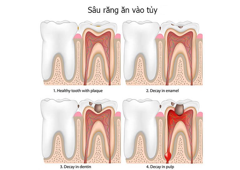 Dấu hiệu nhận biết răng sâu vào tủy