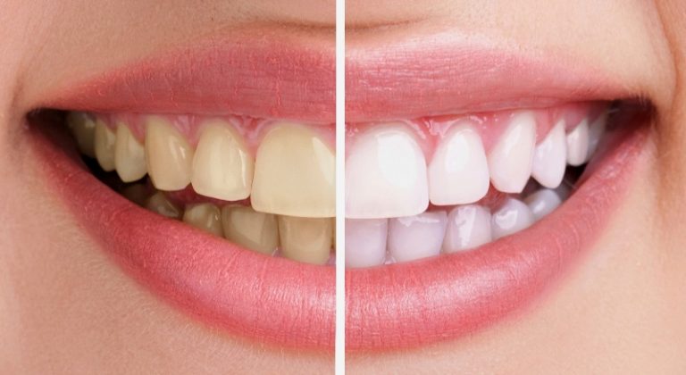 Tẩy trắng răng là phương pháp làm sáng màu răng