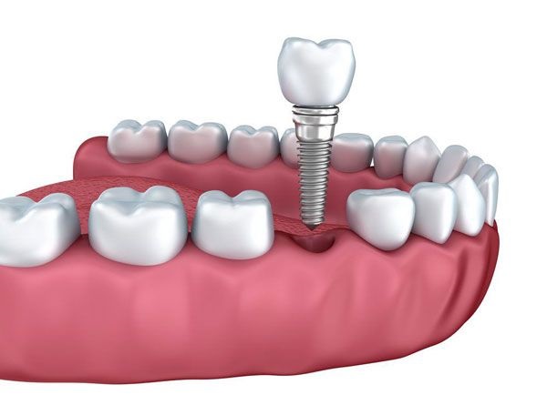 Cấy ghép Implant - Phương pháp giúp thay thế răng số 5 đã mất tốt nhất hiện nay