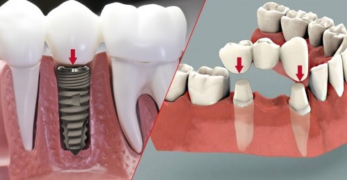 Cấy răng Implant và cầu răng sứ đều có độ thẩm mỹ cao và khả năng ăn nhai tốt.