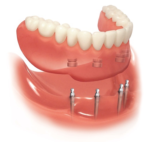 Số lượng trụ Implant cần sử dụng còn phụ thuộc vào số răng mất