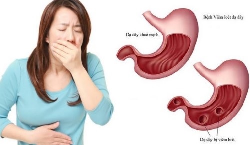 Hôi miệng dạ dày: Nguyên nhân và mẹo chữa “cực nhạy” - Nha khoa Sài Gòn ST