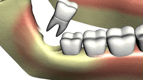 Nhổ mất răng số 8 có nên trồng răng lại không?