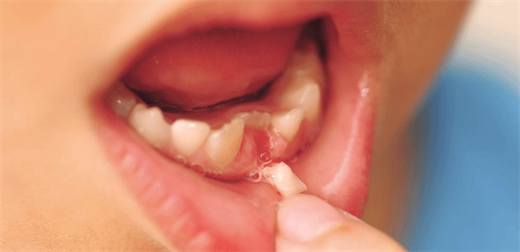 Dấu hiệu nhận biết răng trẻ bị lệch