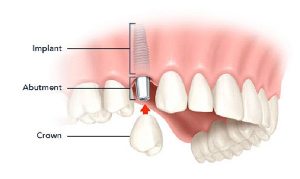 Cấy ghép Implant là phương pháp trồng răng đã mất tốt nhất hiện nay