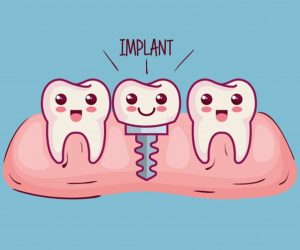 Trồng Răng Implant Loại Nào Tốt Nhất Hiện Nay?