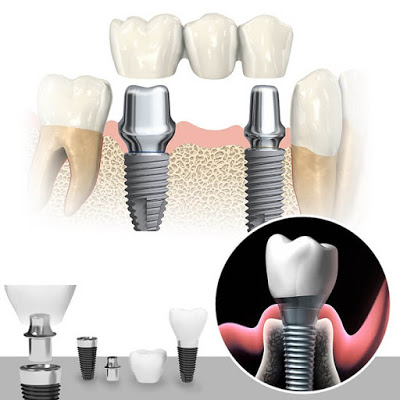 Sẽ có một số trường hợp không nên cấy ghép răng Implant