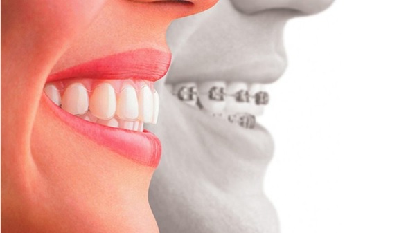 Niềng răng giúp di chuyển các răng về đúng vị trí trên cung hàm