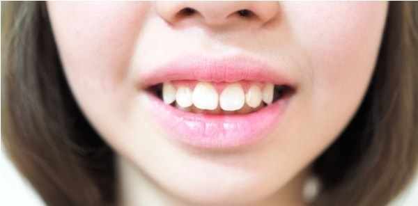 Răng hô vẩu nguyên nhân do răng