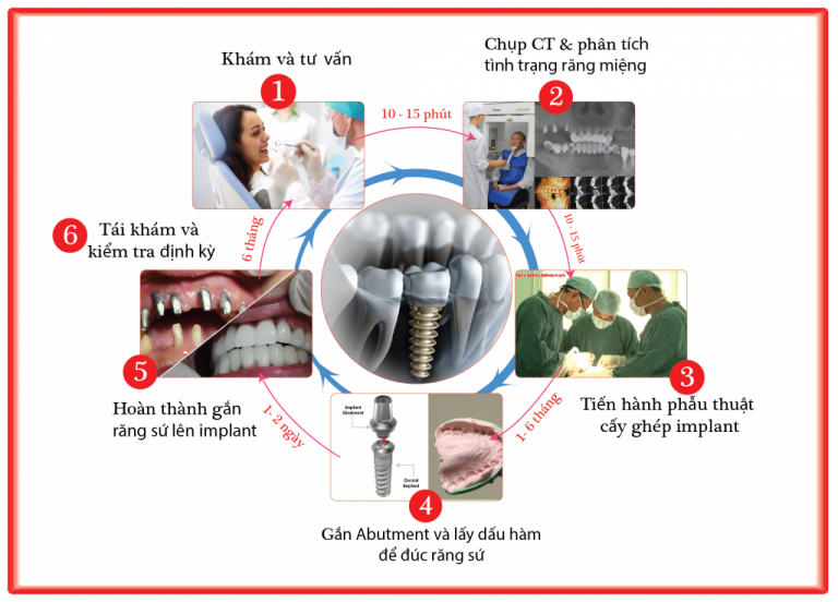 Quy trình làm răng Implant