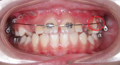 Niềng răng có thể khắc phục được tình trạng răng thưa hiệu quả