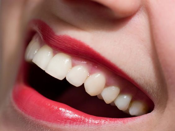 Đắp răng sứ là phương pháp đem đến tính thẩm mỹ cao