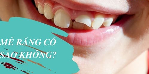 Khi răng bị vỡ, mẻ…sẽ ảnh hưởng đến cấu trúc răng
