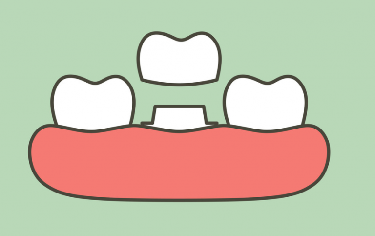 Bọc răng sứ thẩm mỹ giúp khắc phục một số tình trạng răng hô