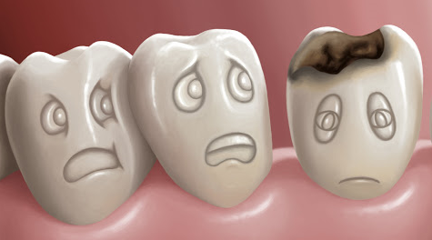 Sâu răng là tình trạng răng bị tổn thương