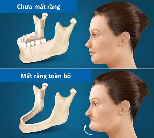 Mất răng dẫn đến tình trạng tiêu xương, lão hóa sớm