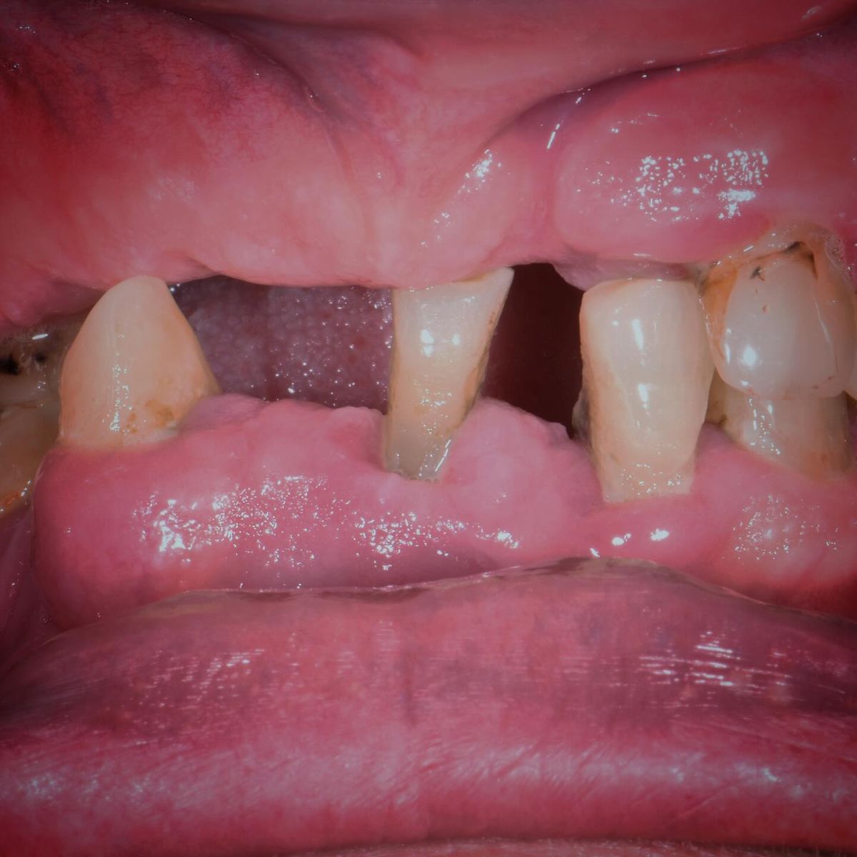 Tiêu Xương Hàm Là Gì Nguyên Nhân Và Giải Pháp Ngăn Ngừa