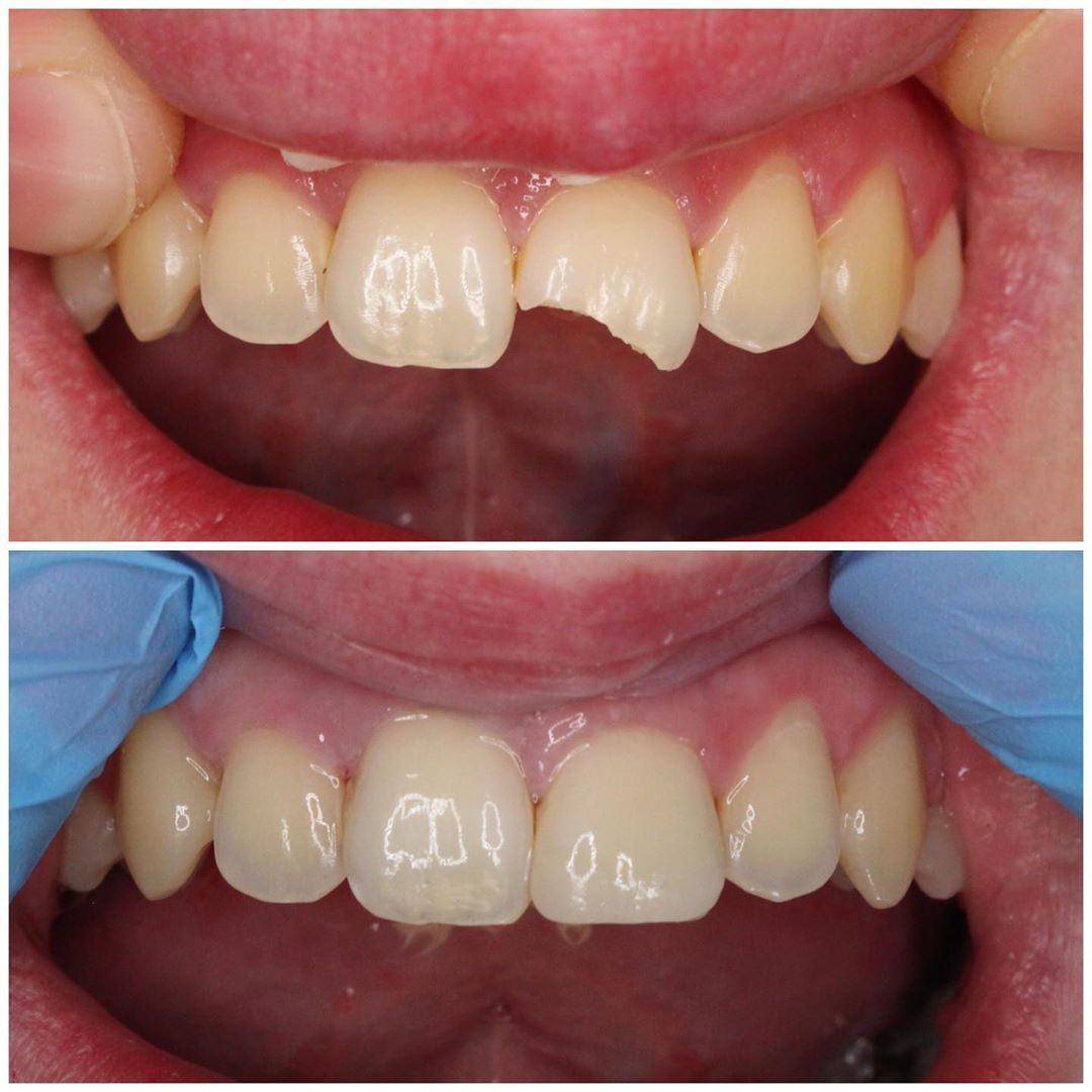 Mẻ Răng Cửa Nguyên Nhân, Hậu Quả Và Giải Pháp Phục Hình