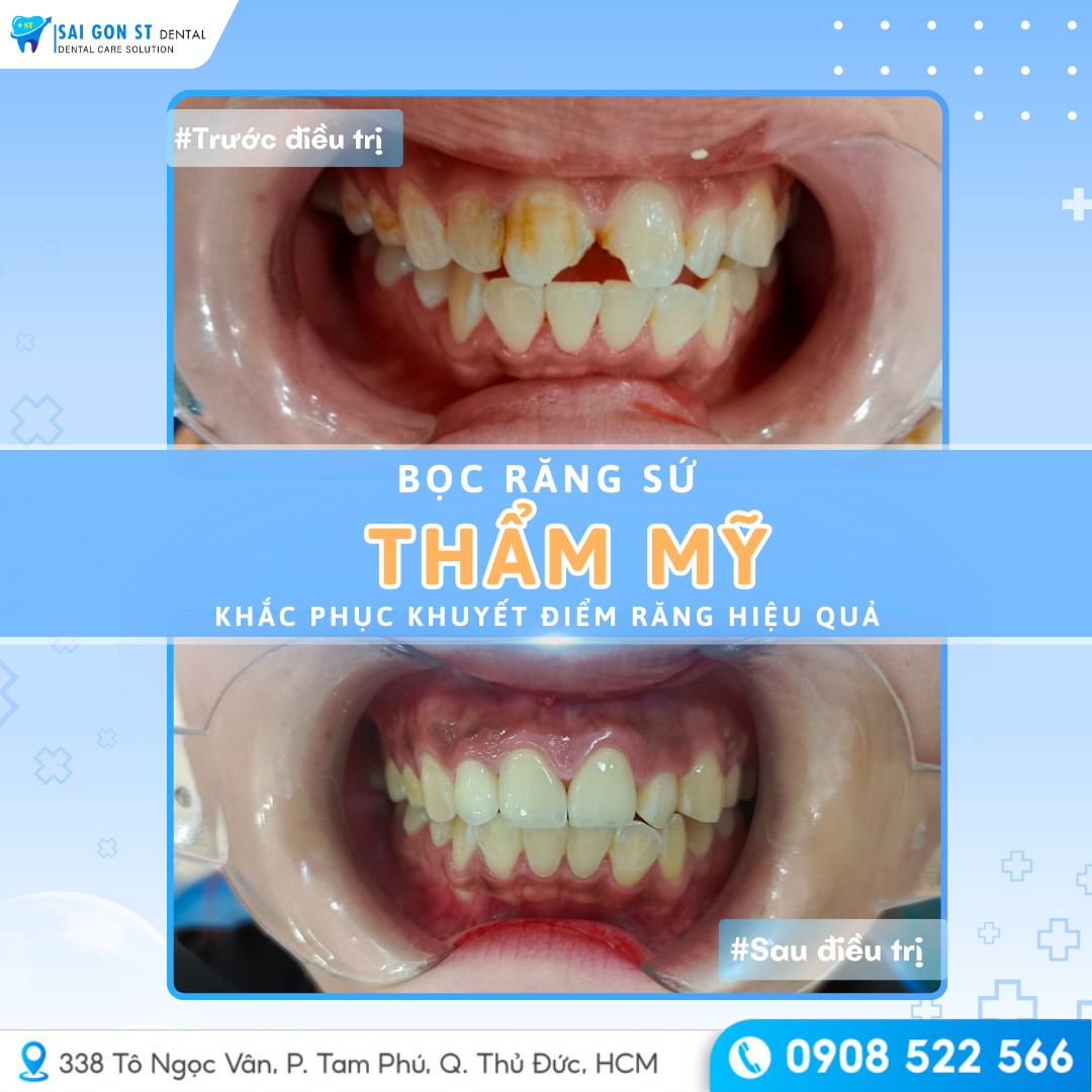 Mẻ Răng Cửa Nguyên Nhân, Hậu Quả Và Giải Pháp Phục Hình