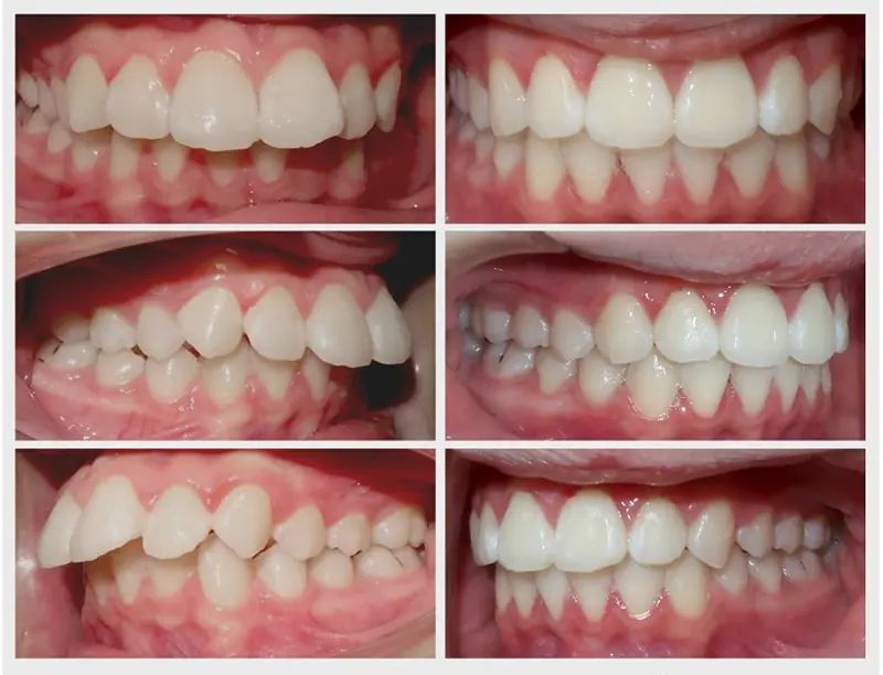 Niềng Răng Hô – Quy Trình Và Phương Pháp Thực Hiện