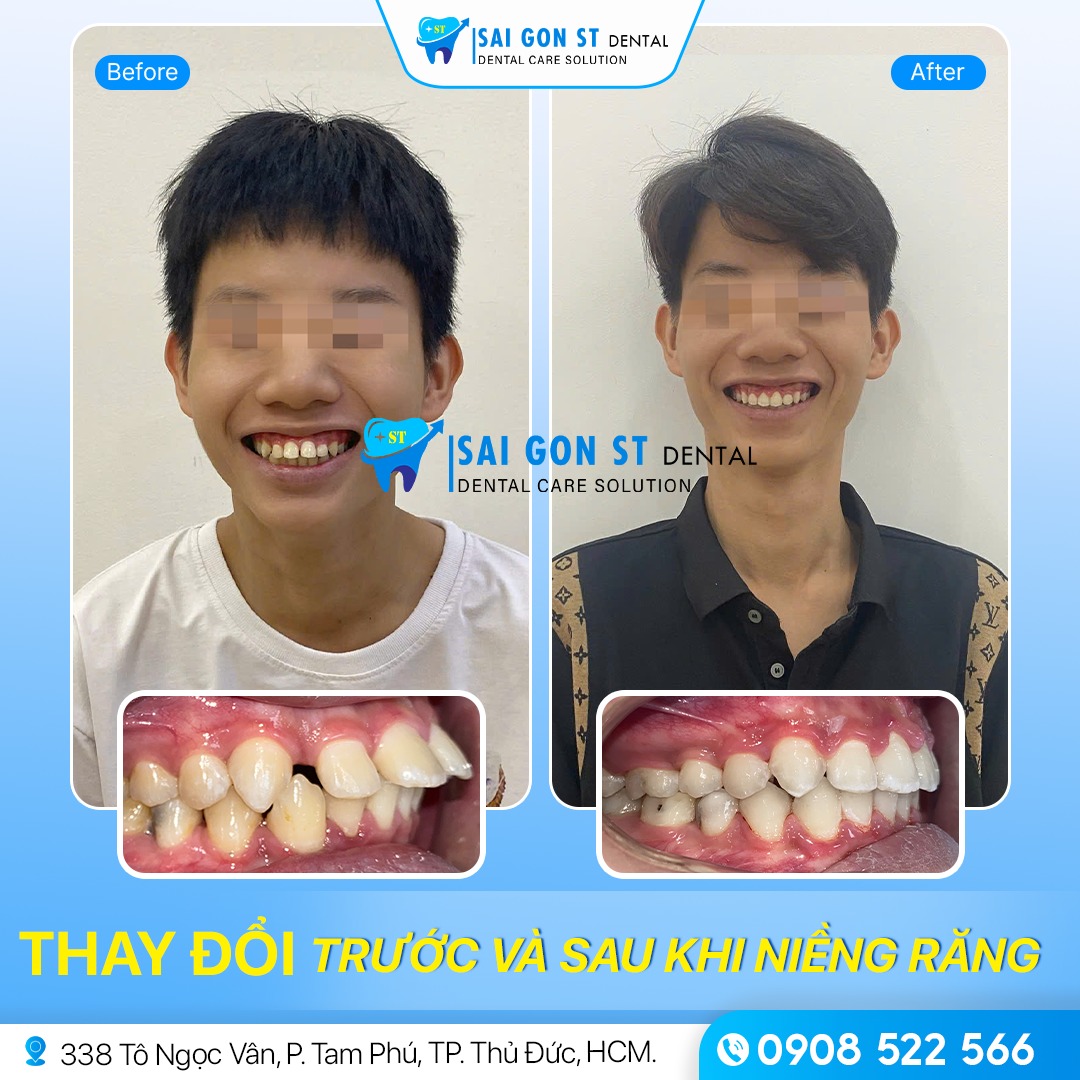 Niềng Răng Hô – Quy Trình Và Phương Pháp Thực Hiện