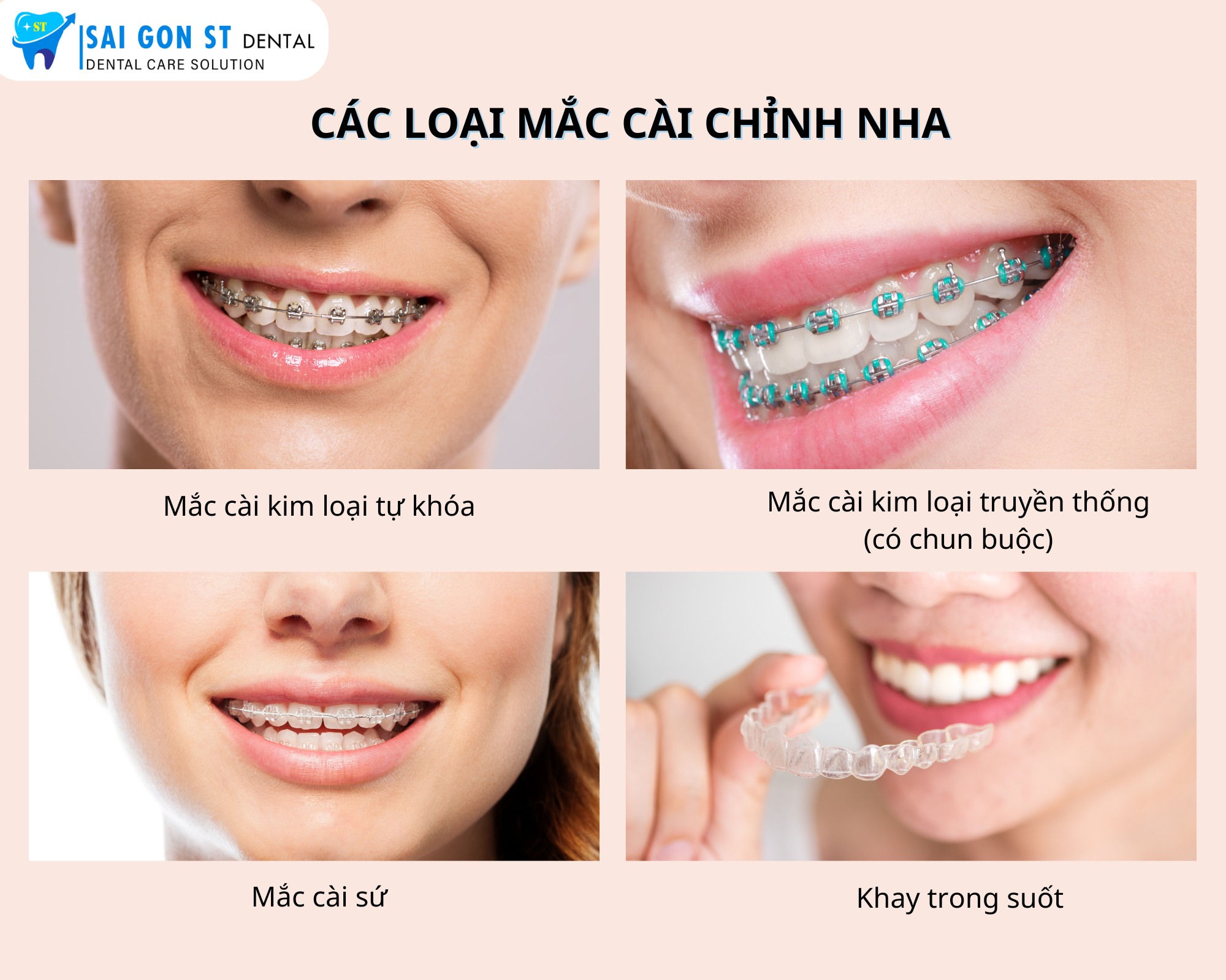 Niềng Răng Hô – Quy Trình Và Phương Pháp Thực Hiện