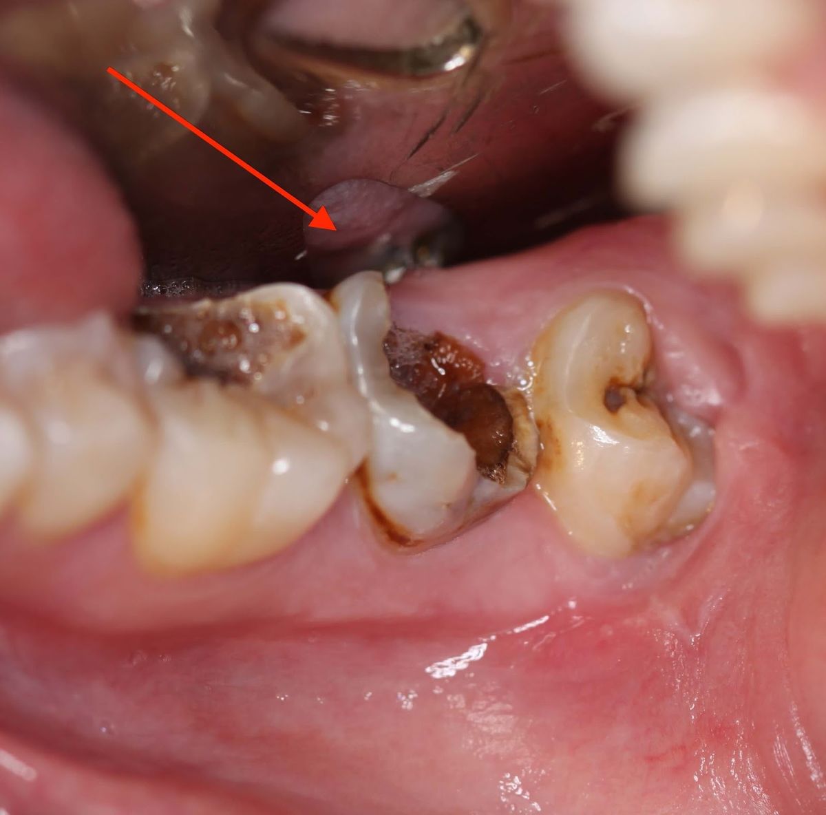 Răng Hàm Bị Sâu Nguyên Nhân, Triệu Chứng Và Cách Điều Trị