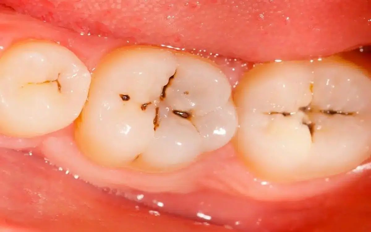 Răng Hàm Bị Sâu Nguyên Nhân, Triệu Chứng Và Cách Điều Trị