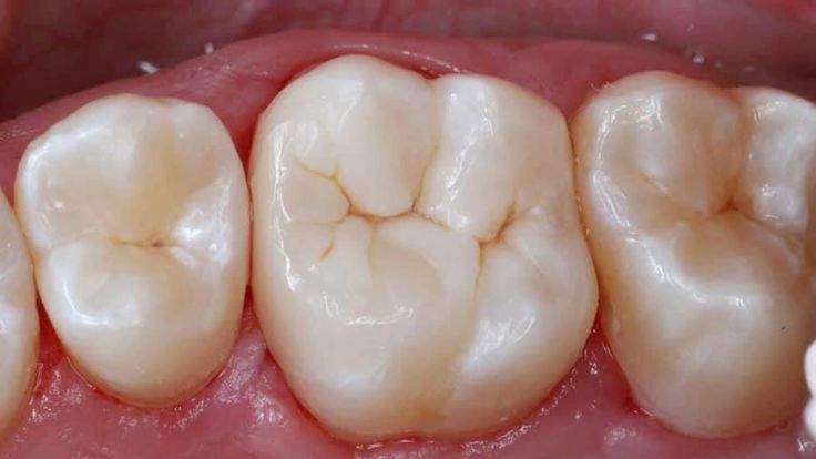 Răng Hàm Bị Sâu Nguyên Nhân, Triệu Chứng Và Cách Điều Trị