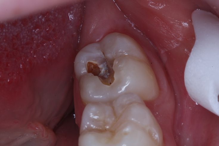 Răng Hàm Bị Sâu Nguyên Nhân, Triệu Chứng Và Cách Điều Trị