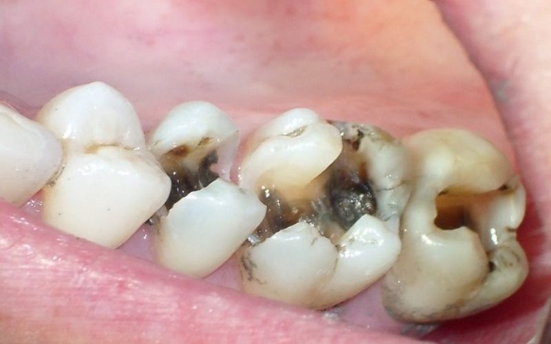 Răng Hàm Bị Sâu Nguyên Nhân, Triệu Chứng Và Cách Điều Trị